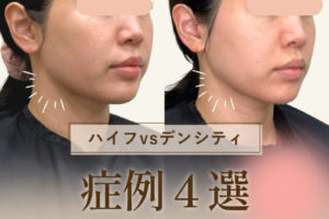 美品ドクタービゼア　ハイフ　ボディハイフ　フェイスハイフ 美品ドクタービゼア ハイフ ボディハイフ フェイスハイフ 美品